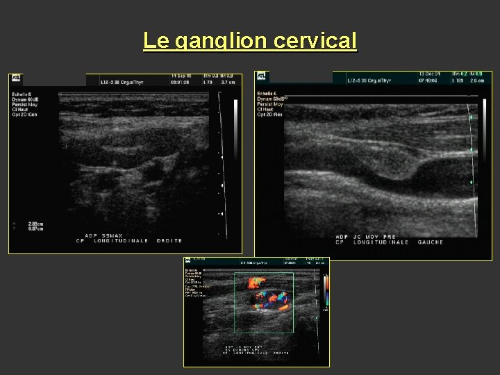 Le ganglion cervical 