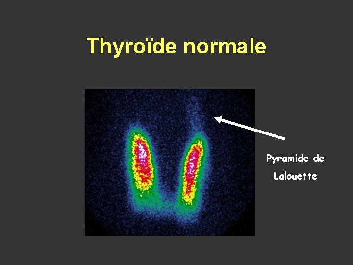 Thyroïde normale Pyramide de Lalouette 