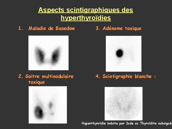 Aspects scintigraphiques des hyperthyroïdies 1. Maladie de Basedow 3. Adénome toxique 2. Goitre multinodulaire