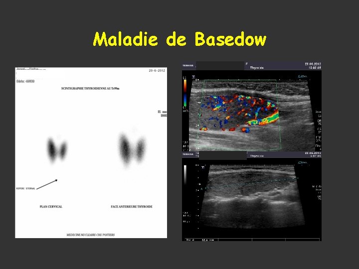 Maladie de Basedow 