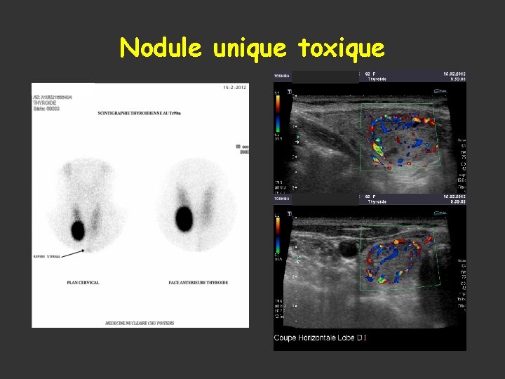 Nodule unique toxique 