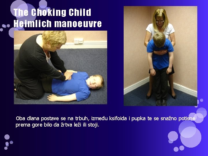 The Choking Child Heimlich manoeuvre Oba dlana postave se na trbuh, između ksifoida i