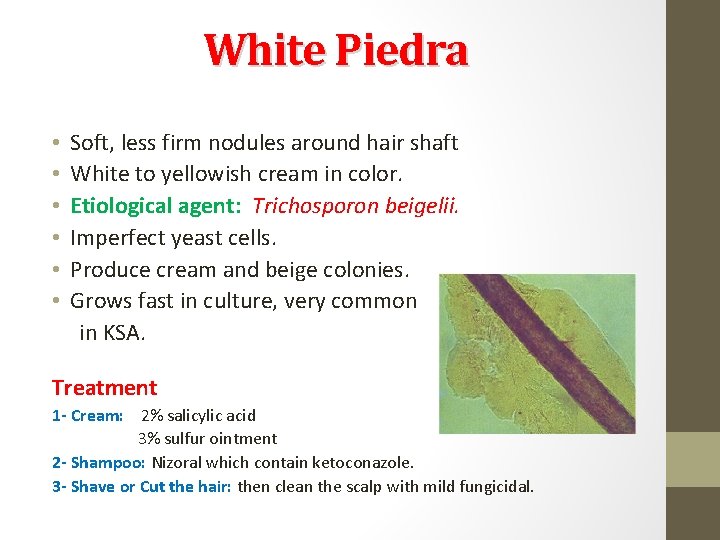 White Piedra • • • Soft, less firm nodules around hair shaft White to