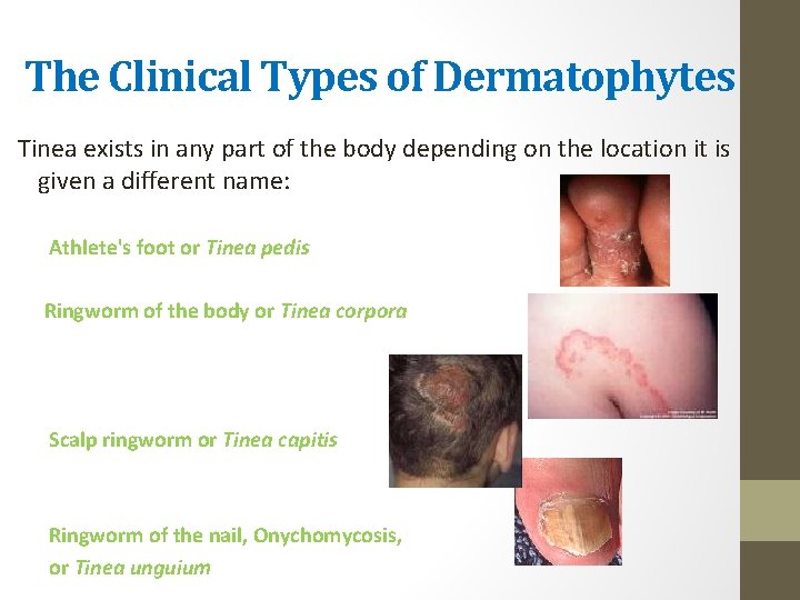 The Clinical Types of Dermatophytes Tinea exists in any part of the body depending