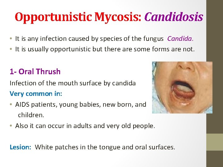 Opportunistic Mycosis: Candidosis • It is any infection caused by species of the fungus