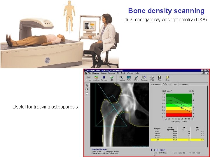 Bone density scanning =dual-energy x-ray absorptiometry (DXA) Useful for tracking osteoporosis 