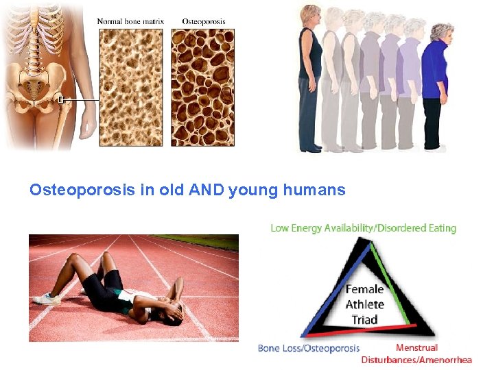 Osteoporosis in old AND young humans 
