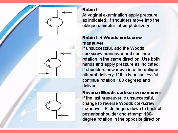 Rubin II At vaginal examination apply pressure as indicated. If shoulders move into the