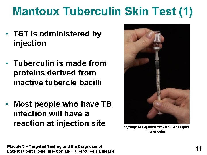 Mantoux Tuberculin Skin Test (1) • TST is administered by injection • Tuberculin is