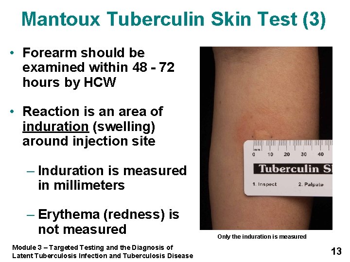 Mantoux Tuberculin Skin Test (3) • Forearm should be examined within 48 - 72