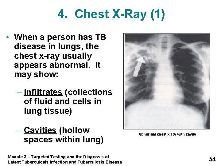 4. Chest X-Ray (1) • When a person has TB disease in lungs, the