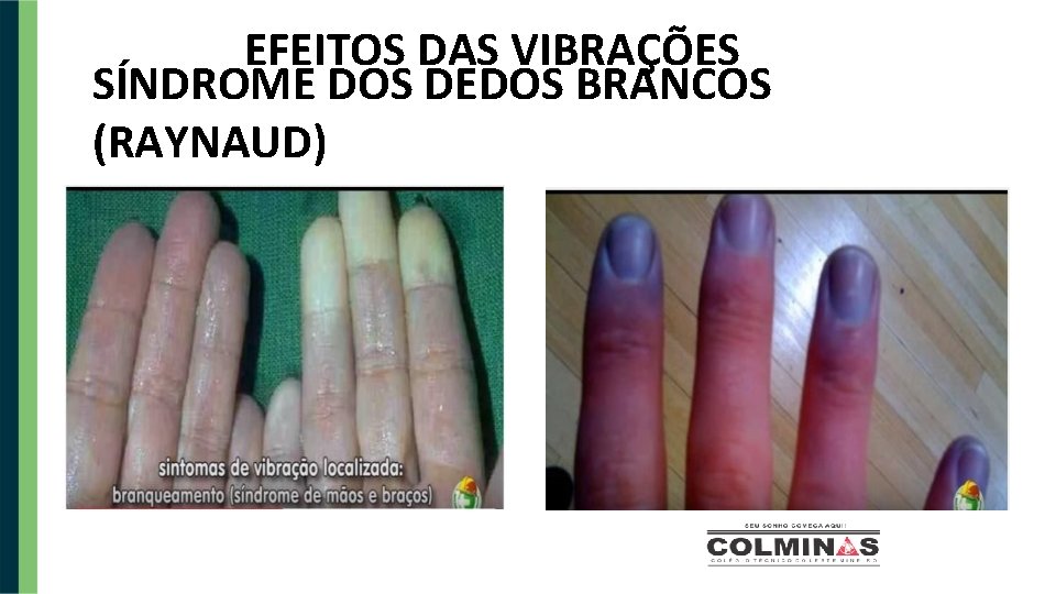 EFEITOS DAS VIBRAÇÕES SÍNDROME DOS DEDOS BRANCOS (RAYNAUD) 