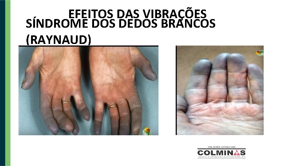 EFEITOS DAS VIBRAÇÕES SÍNDROME DOS DEDOS BRANCOS (RAYNAUD) 