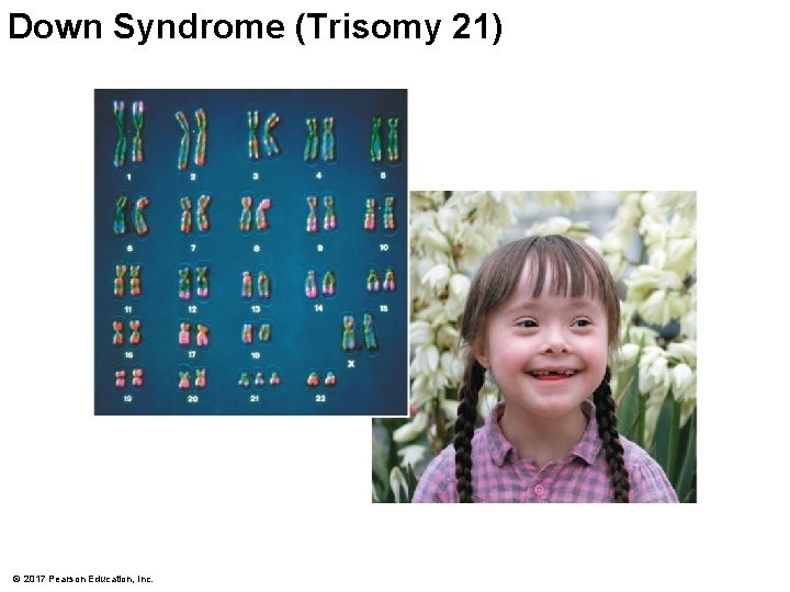 Down Syndrome (Trisomy 21) © 2017 Pearson Education, Inc. 