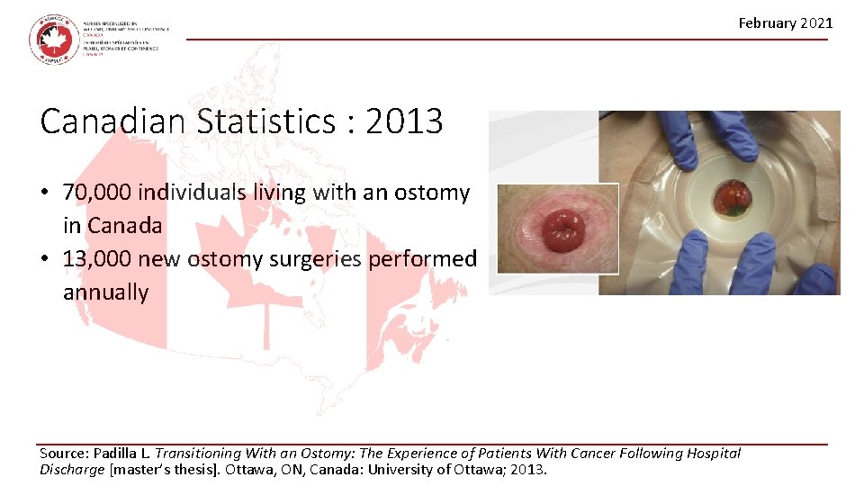 February 2021 Canadian Statistics : 2013 • 70, 000 individuals living with an ostomy