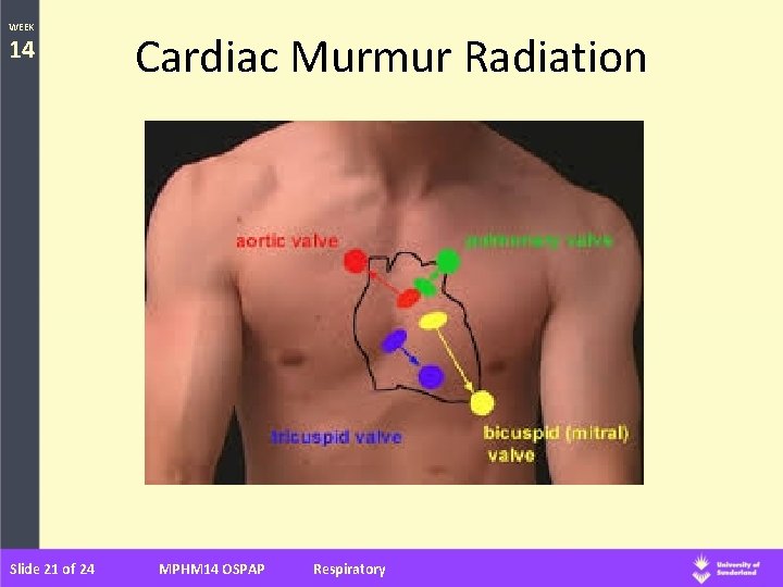 WEEK 14 Slide 21 of 24 Cardiac Murmur Radiation MPHM 14 OSPAP Respiratory 