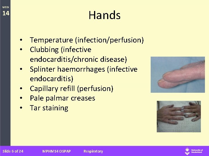 WEEK Hands 14 • Temperature (infection/perfusion) • Clubbing (infective endocarditis/chronic disease) • Splinter haemorrhages WEEK Hands 14 • Temperature (infection/perfusion) • Clubbing (infective endocarditis/chronic disease) • Splinter haemorrhages