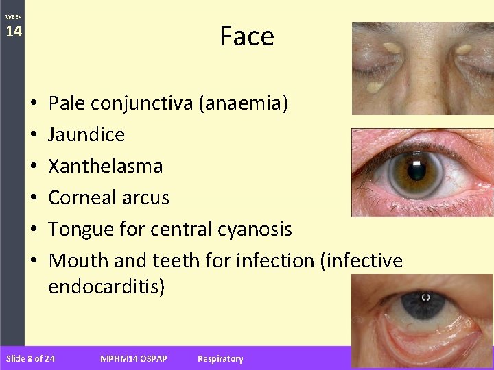 WEEK Face 14 • • • Pale conjunctiva (anaemia) Jaundice Xanthelasma Corneal arcus Tongue