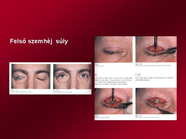 Felső szemhéj súly 