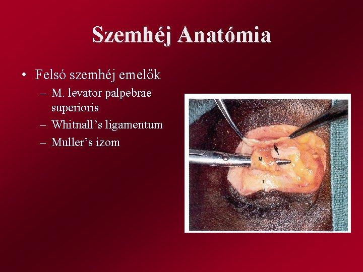 Szemhéj Anatómia • Felsó szemhéj emelők – M. levator palpebrae superioris – Whitnall’s ligamentum