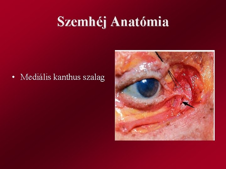 Szemhéj Anatómia • Mediális kanthus szalag 