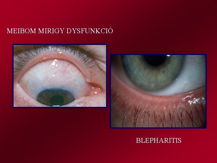 MEIBOM MIRIGY DYSFUNKCIÓ BLEPHARITIS 