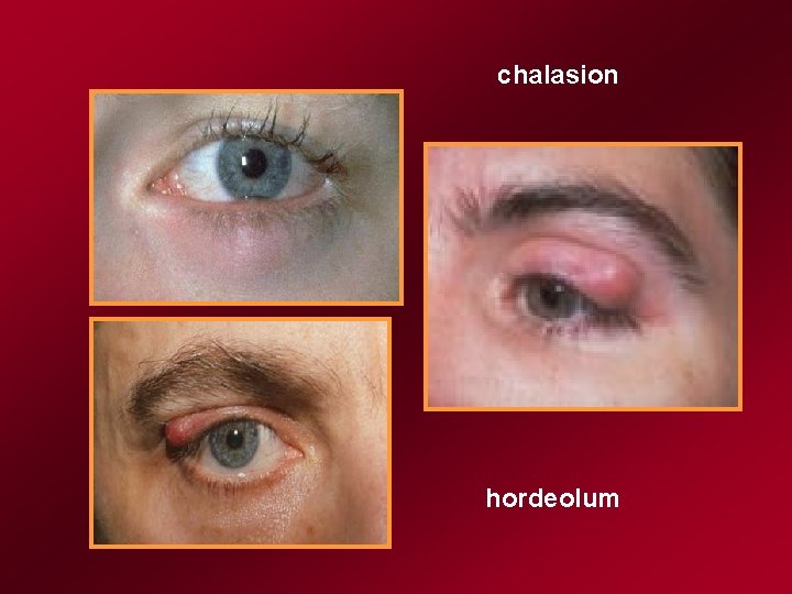 chalasion hordeolum 