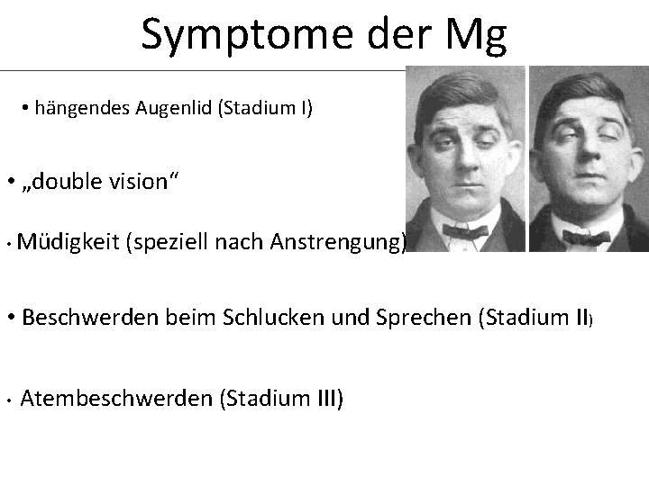 Symptome der Mg • hängendes Augenlid (Stadium I) • „double vision“ • Müdigkeit (speziell