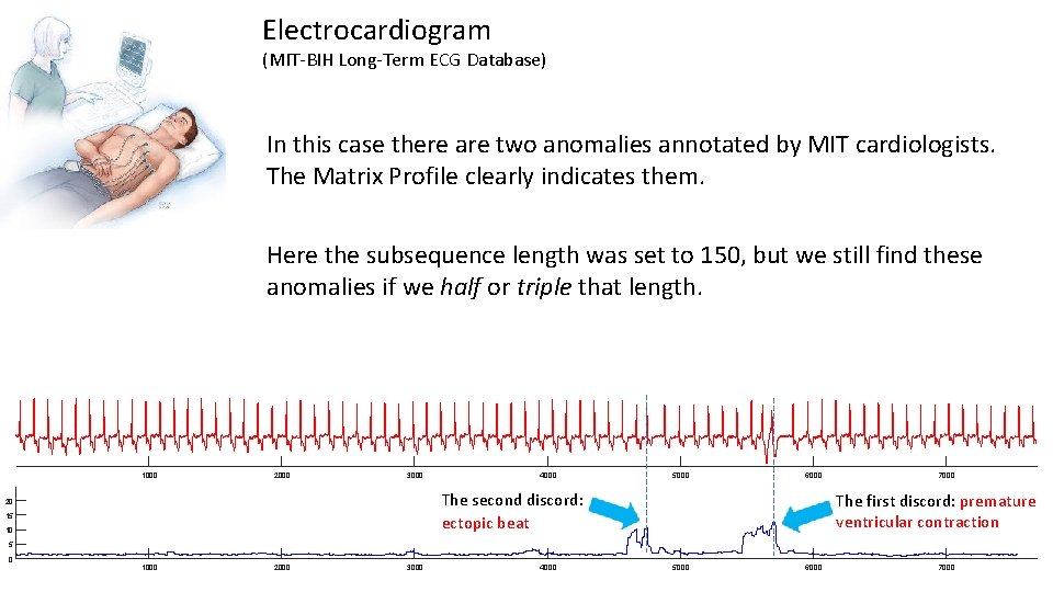 Electrocardiogram (MIT-BIH Long-Term ECG Database) In this case there are two anomalies annotated by