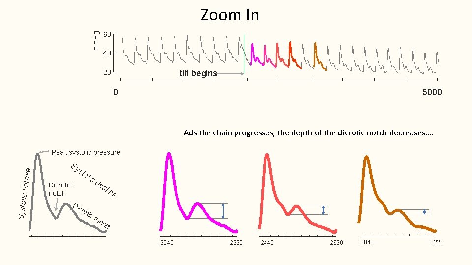 Zoom In mm. Hg 60 40 tilt begins 20 0 5000 Ads the chain