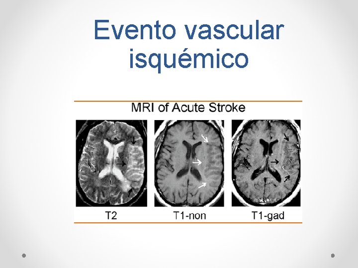 Evento vascular isquémico 