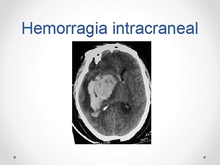 Hemorragia intracraneal 