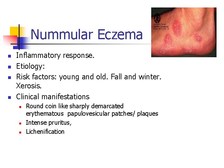 Nummular Eczema n n Inflammatory response. Etiology: Risk factors: young and old. Fall and