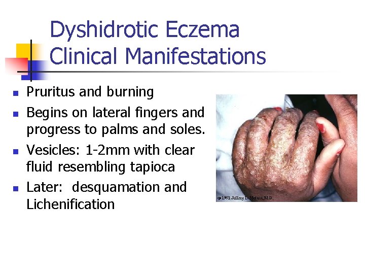 Dyshidrotic Eczema Clinical Manifestations n n Pruritus and burning Begins on lateral fingers and