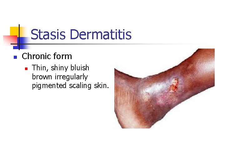 Stasis Dermatitis n Chronic form n Thin, shiny bluish brown irregularly pigmented scaling skin.