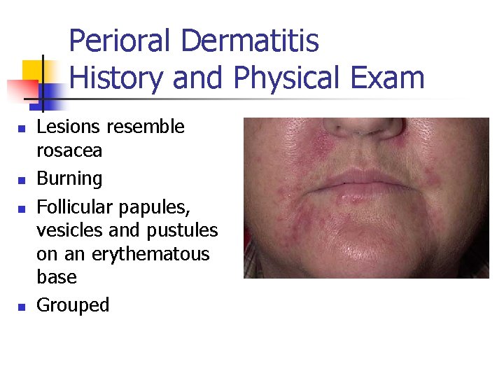 Perioral Dermatitis History and Physical Exam n n Lesions resemble rosacea Burning Follicular papules,