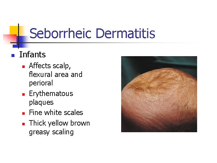 Seborrheic Dermatitis n Infants n n Affects scalp, flexural area and perioral Erythematous plaques