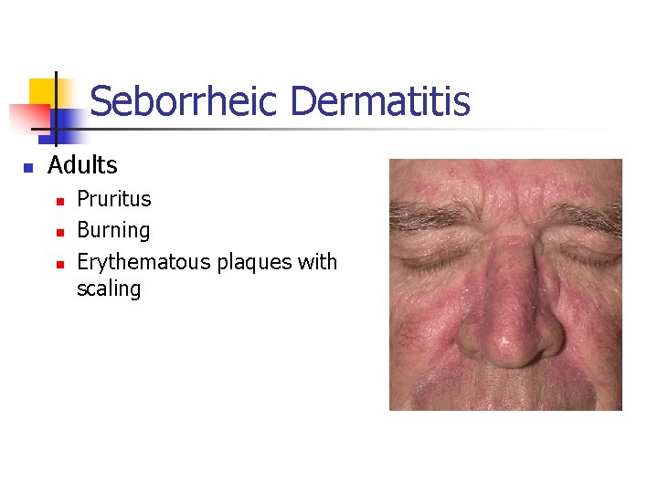 Seborrheic Dermatitis n Adults n n n Pruritus Burning Erythematous plaques with scaling 