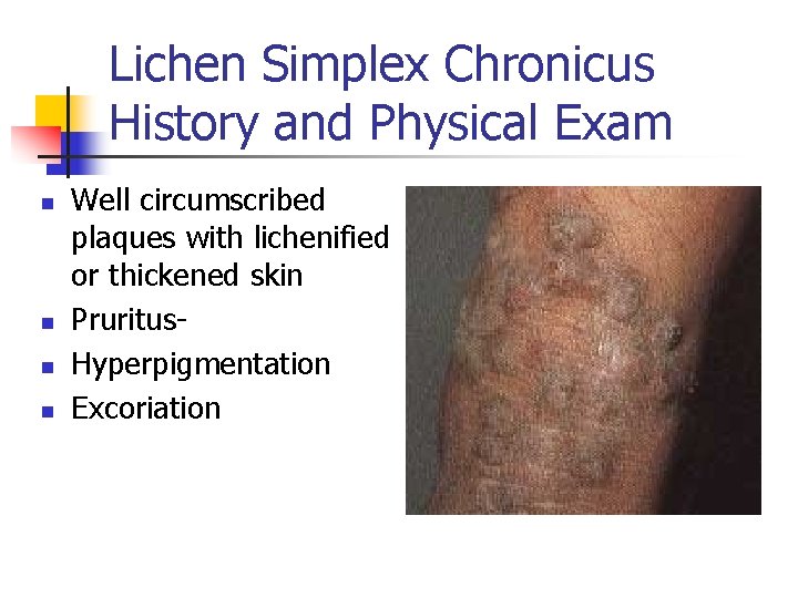 Lichen Simplex Chronicus History and Physical Exam n n Well circumscribed plaques with lichenified