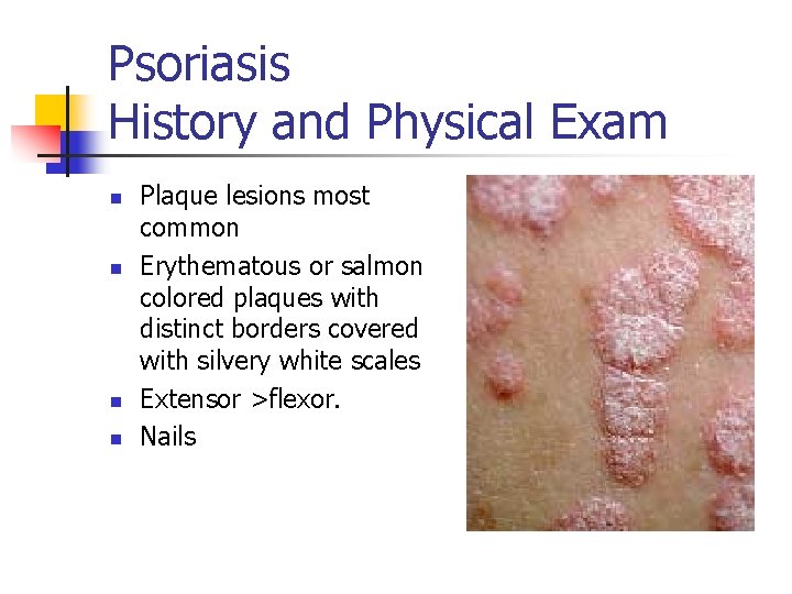 Psoriasis History and Physical Exam n n Plaque lesions most common Erythematous or salmon