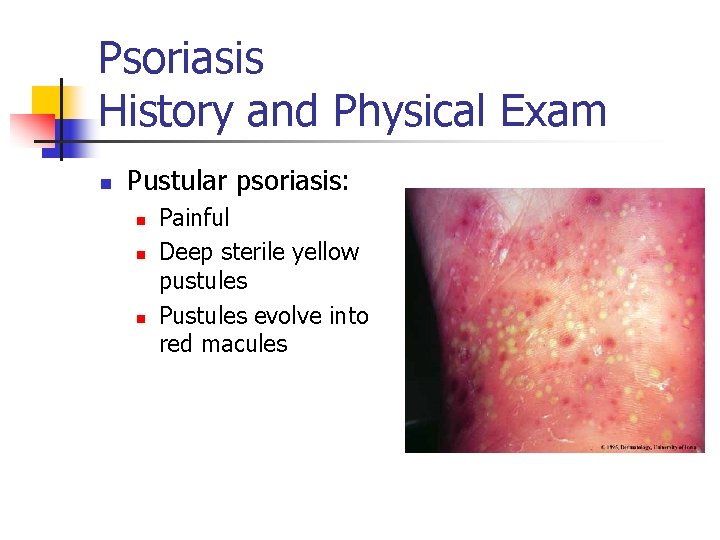 Psoriasis History and Physical Exam n Pustular psoriasis: n n n Painful Deep sterile