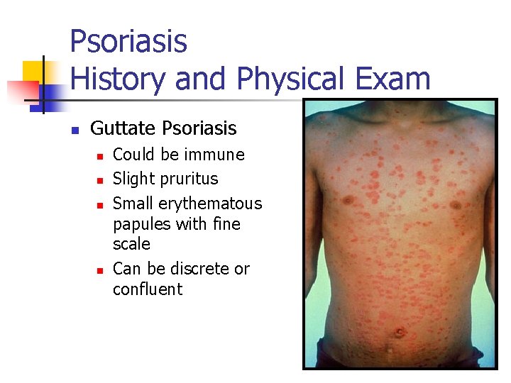 Psoriasis History and Physical Exam n Guttate Psoriasis n n Could be immune Slight
