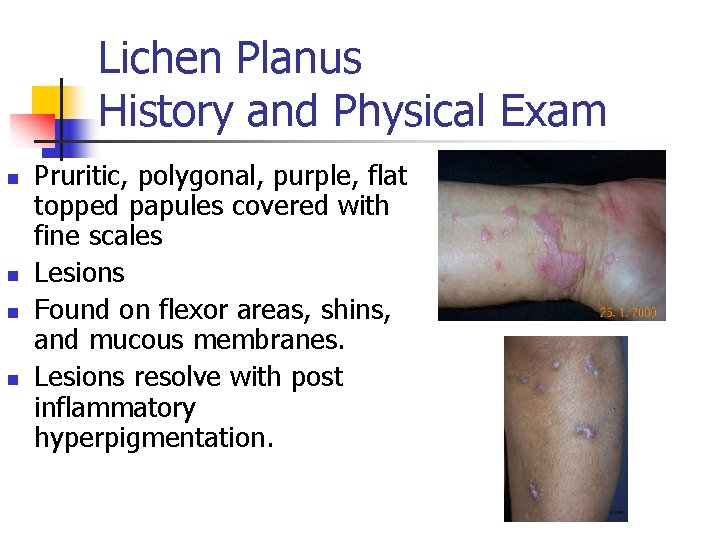 Lichen Planus History and Physical Exam n n Pruritic, polygonal, purple, flat topped papules