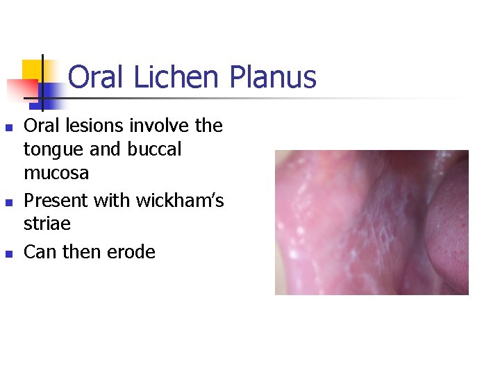 Oral Lichen Planus n n n Oral lesions involve the tongue and buccal mucosa
