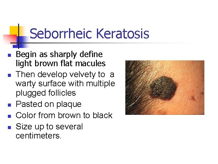 Seborrheic Keratosis n n n Begin as sharply define light brown flat macules Then