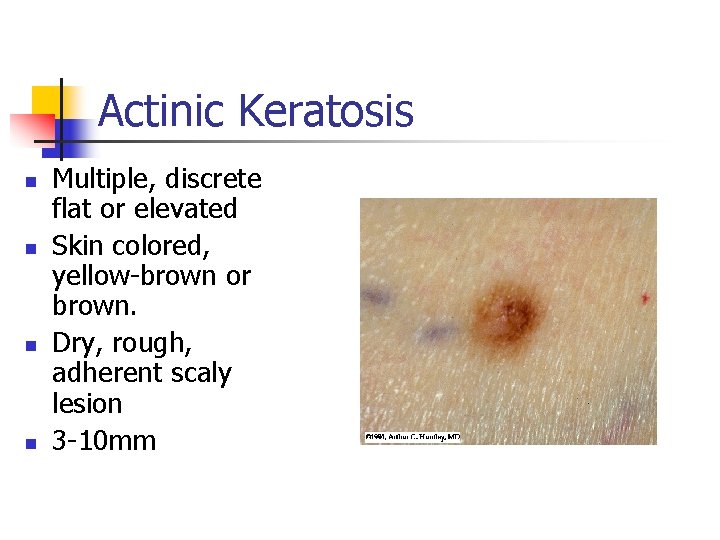 Actinic Keratosis n n Multiple, discrete flat or elevated Skin colored, yellow-brown or brown.