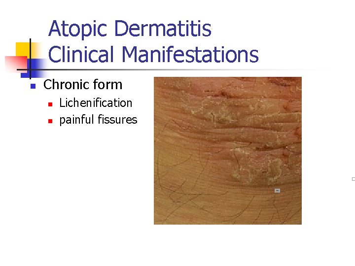 Atopic Dermatitis Clinical Manifestations n Chronic form n n Lichenification painful fissures 