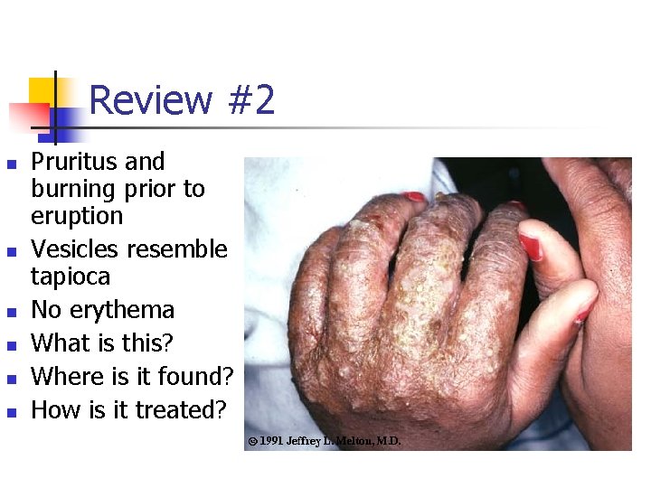 Review #2 n n n Pruritus and burning prior to eruption Vesicles resemble tapioca