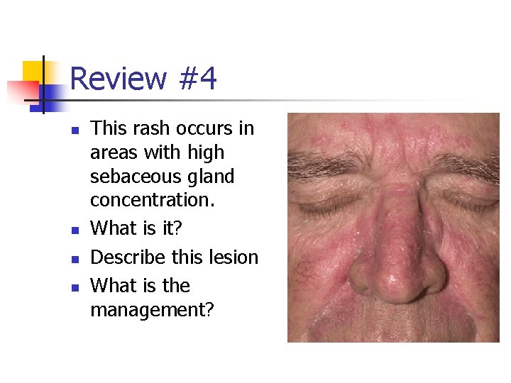 Review #4 n n This rash occurs in areas with high sebaceous gland concentration.