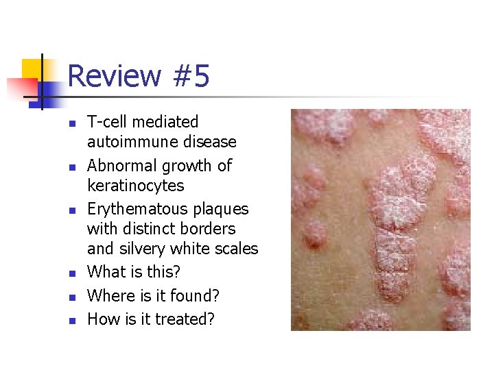Review #5 n n n T-cell mediated autoimmune disease Abnormal growth of keratinocytes Erythematous